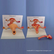 Modèle d&#39;anatomie de l&#39;utérus morbide mâle pour l&#39;enseignement médical (R110201)